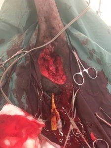 vaginal leiomyosarcoma4