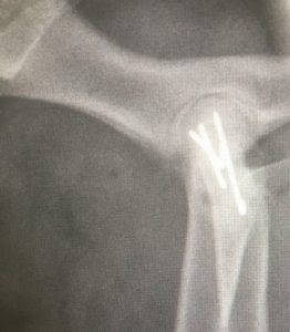 femoral capital physis fracture4