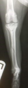 tibia fracture1