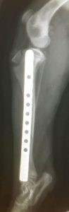 tibia fracture2