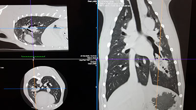 Endoscopic removal of foreign bodies