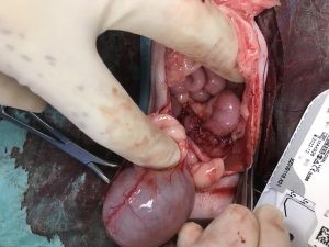 colectomy2
