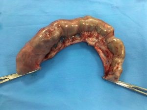 colectomy3