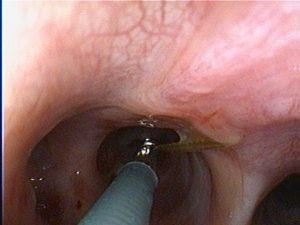 endoscopic removal2